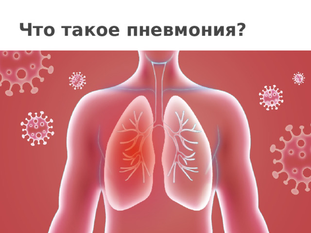 Что такое пневмония?