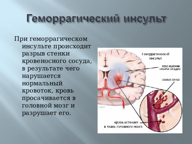 При геморрагическом инсульте происходит разрыв стенки кровеносного сосуда, в результате чего нарушается нормальный кровоток, кровь просачивается в головной мозг и разрушает его.