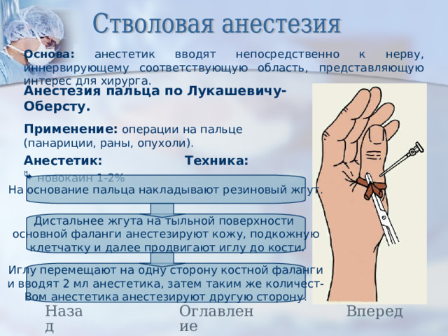 Основа: анестетик вводят непосредственно к нерву, иннервирующему соответствующую область, представляющую интерес для хирурга. Анестезия пальца по Лукашевичу-Оберсту. Применение: операции на пальце (панариции, раны, опухоли). Анестетик: Техника:  новокаин 1-2% На основание пальца накладывают резиновый жгут. Дистальнее жгута на тыльной поверхности основной фаланги анестезируют кожу, подкожную  клетчатку и далее продвигают иглу до кости. Иглу перемещают на одну сторону костной фаланги и вводят 2 мл анестетика, затем таким же количест- Вом анестетика анестезируют другую сторону. Назад Вперед Оглавление