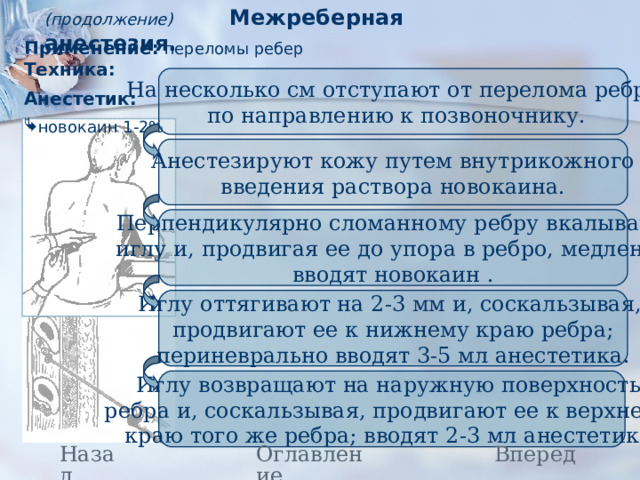 (продолжение) Межреберная анестезия.  Применение: переломы ребер Техника: Анестетик:  новокаин 1-2% На несколько см отступают от перелома ребра  по направлению к позвоночнику. Анестезируют кожу путем внутрикожного введения раствора новокаина. Перпендикулярно сломанному ребру вкалывают  иглу и, продвигая ее до упора в ребро, медленно вводят новокаин . Иглу оттягивают на 2-3 мм и, соскальзывая, продвигают ее к нижнему краю ребра; периневрально вводят 3-5 мл анестетика. Иглу возвращают на наружную поверхность ребра и, соскальзывая, продвигают ее к верхнему краю того же ребра; вводят 2-3 мл анестетика. Назад Вперед Оглавление