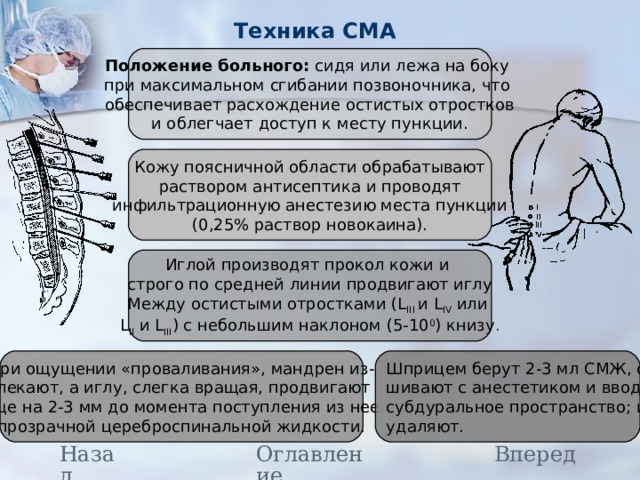 Техника СМА Положение больного: сидя или лежа на боку при максимальном сгибании позвоночника, что обеспечивает расхождение остистых отростков и облегчает доступ к месту пункции. Кожу поясничной области обрабатывают раствором антисептика и проводят инфильтрационную анестезию места пункции (0,25% раствор новокаина). Иглой производят прокол кожи и строго по средней линии продвигают иглу Между остистыми отростками ( L III  и L IV  или L II и L III ) с небольшим наклоном (5-10 0 ) книзу . При ощущении «проваливания», мандрен из- влекают, а иглу, слегка вращая, продвигают еще на 2-3 мм до момента поступления из нее прозрачной цереброспинальной жидкости. Шприцем берут 2-3 мл СМЖ, сме- шивают с анестетиком и вводят в субдуральное пространство; иглу удаляют. Назад Вперед Оглавление