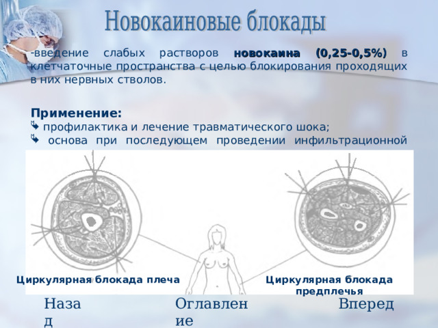 введение слабых растворов новокаина (0,25-0,5%) в клетчаточные пространства с целью блокирования проходящих в них нервных стволов. Применение:  профилактика и лечение травматического шока;  основа при последующем проведении инфильтрационной анестезии;  лечение некоторых воспалительных заболеваний.