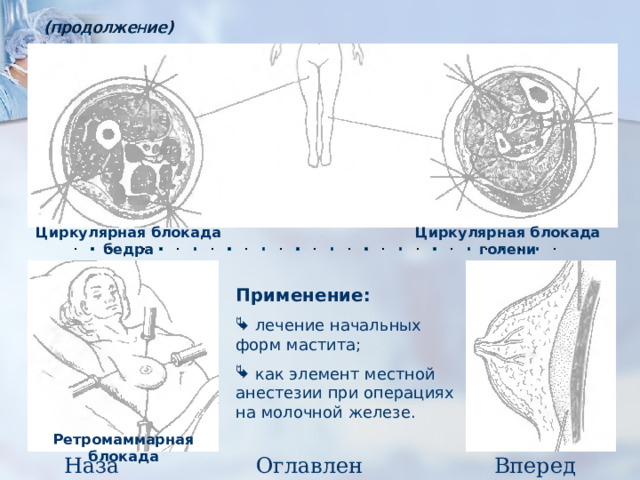 (продолжение) Циркулярная блокада голени Циркулярная блокада бедра Применение:  лечение начальных форм мастита;  как элемент местной анестезии при операциях на молочной железе. Ретромаммарная блокада Назад Оглавление Вперед