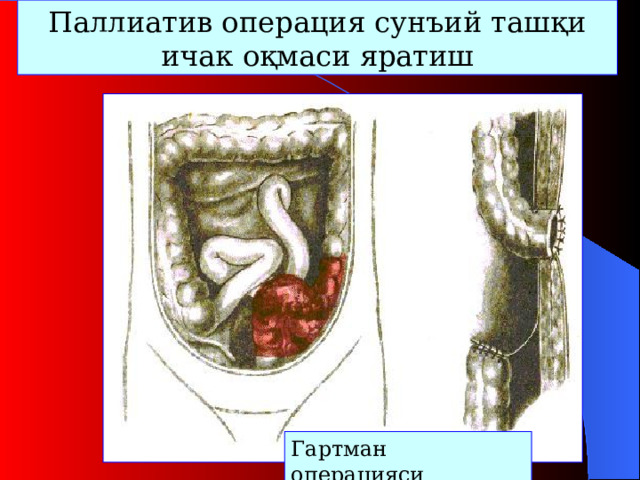 П аллиатив операция сунъий ташқи ичак оқмаси яратиш Гартман  операцияси