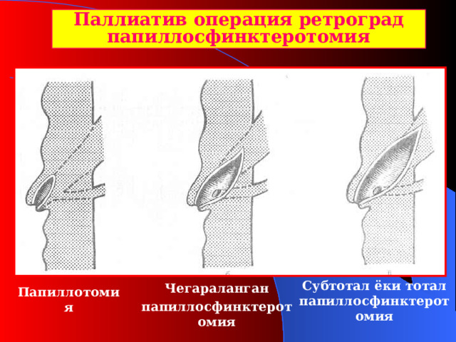 Паллиатив операция ретроград папиллосфинктеротомия С убтотал ёки тотал папиллосфинктеротомия Чегараланган папиллосфин ктеро томия Папиллотомия