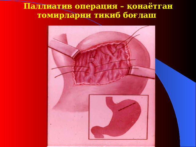 Паллиатив операция – қ онаётган томирларни тикиб бо ғ лаш