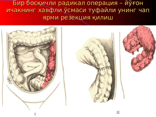 Бир босқичли радикал операция – йўғон ичакнинг хавфли ўсмаси туфайли унинг чап ярми резекция қилиш