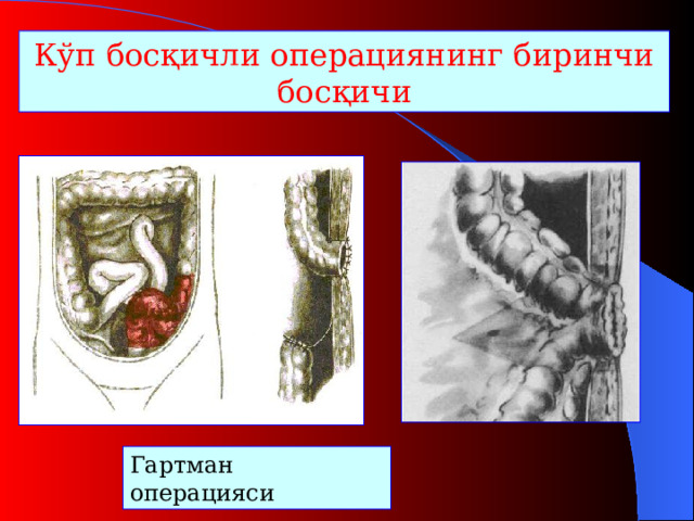 Кўп босқичли операциянинг биринчи босқичи Гартман операцияси