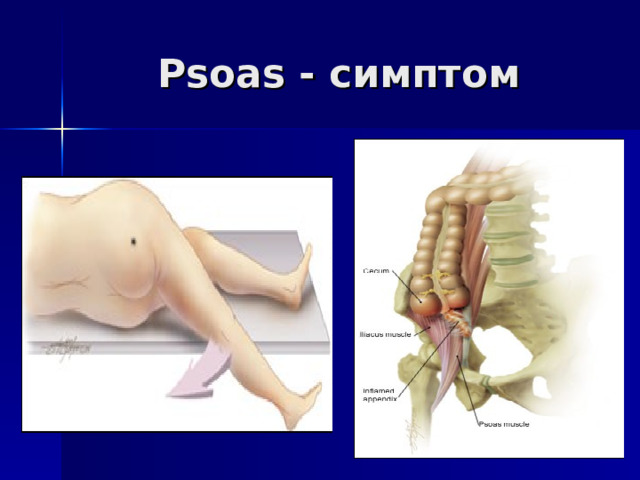 Psoas - симптом