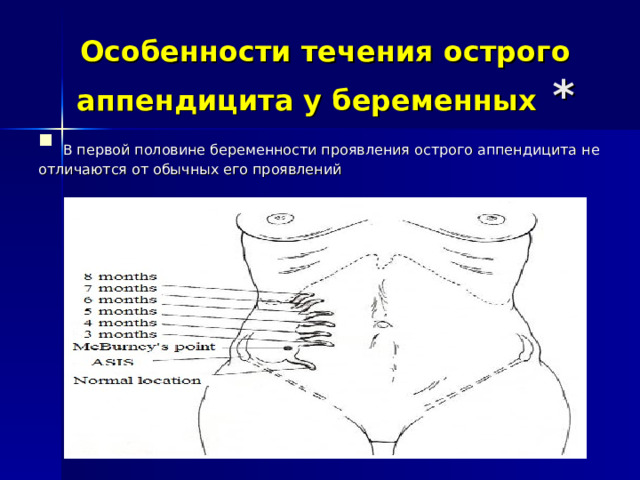 Особенности течения острого аппендицита у беременных  *