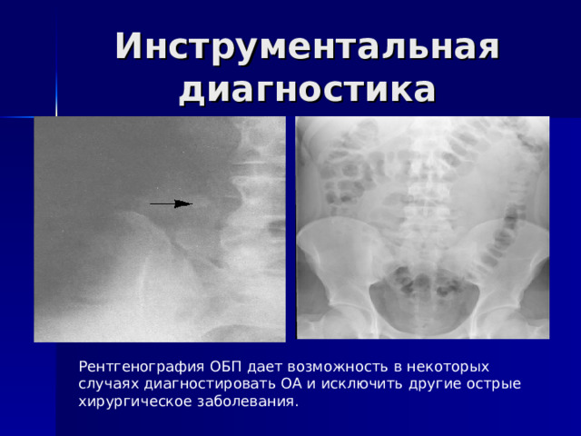 Инструментальная диагностика Рентгенография ОБП дает возможность в некоторых случаях диагностировать ОА и исключить другие острые хирургическое заболевания.