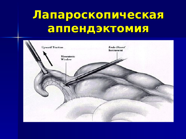 Лапароскопическая аппендэктомия