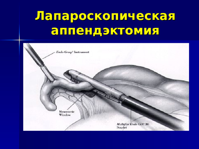 Лапароскопическая аппендэктомия