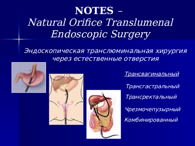 NOTES – Natural Orifice Translumenal Endoscopic Surgery Эндоскопическая транслюминальная хирургия через естественные отверстия Трансвагинальный Трансгастральный Трансректальный Чрезмочепузырный Комбинированный