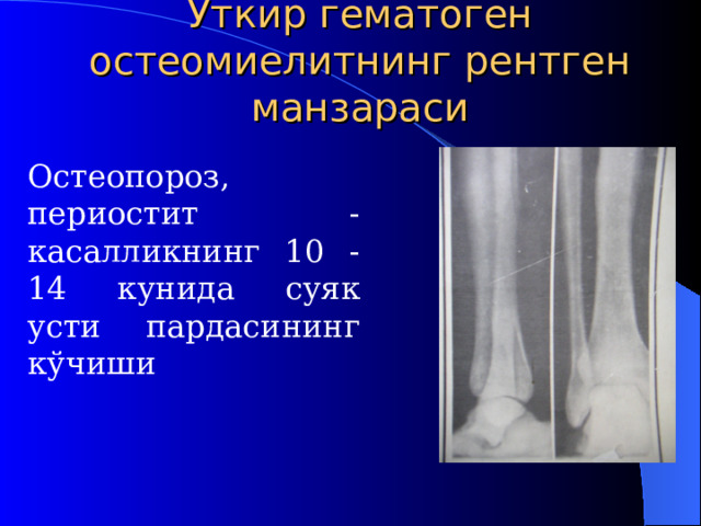 Ўткир гематоген остеомиелитнинг рентген манзараси  Остеопороз, периостит  - касалликнинг 10 - 14 кунида суяк усти пардасининг кўчиши