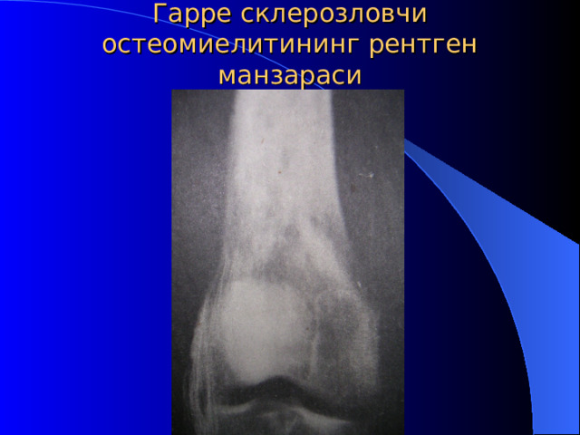 Гарре с клероз ловчи остеомиелит ининг рентген манзараси