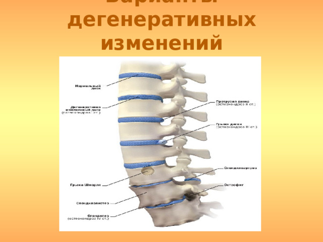 Варианты дегенеративных изменений позвоночника