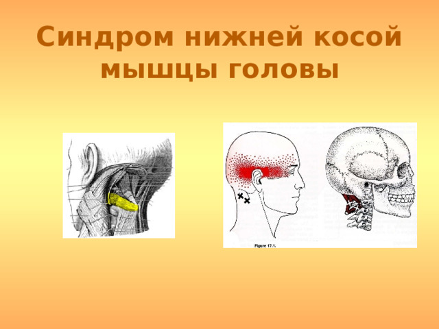 Синдром нижней косой мышцы головы