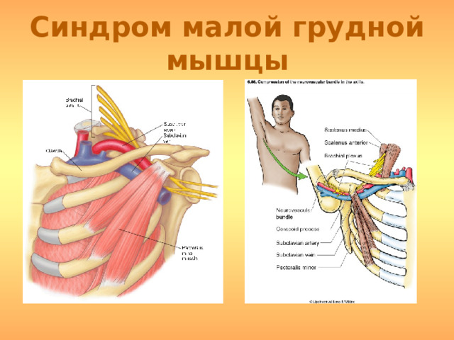 Синдром малой грудной мышцы