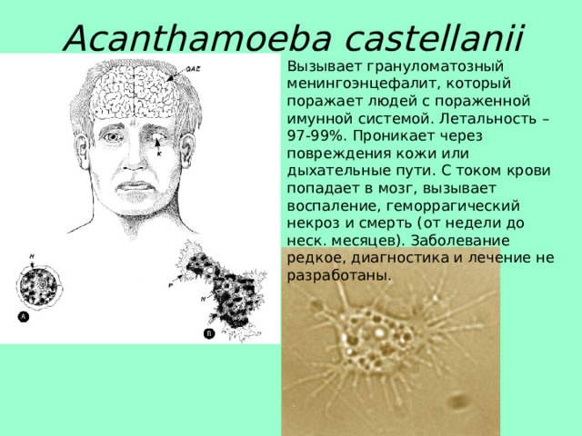 Acanthamoeba castellanii Вызывает грануломатозный менингоэнцефалит, который поражает людей с пораженной имунной системой. Летальность – 97-99%. Проникает через повреждения кожи или дыхательные пути. С током крови попадает в мозг, вызывает воспаление, геморрагический некроз и смерть (от недели до неск. месяцев). Заболевание редкое, диагностика и лечение не разработаны.