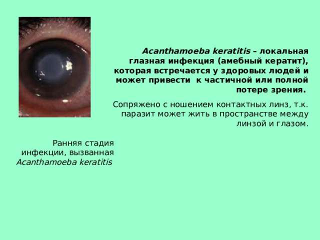 Acanthamoeba  keratitis – локальная глазная инфекция (амебный кератит), которая встречается у здоровых людей и может привести к частичной или полной потере зрения.  Сопряжено с ношением контактных линз, т.к. паразит может жить в пространстве между линзой и глазом. Ранняя стадия инфекции, вызванная Acanthamoeba  keratitis