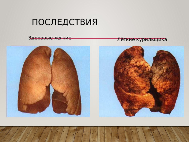 Последствия Здоровые лёгкие Лёгкие курильщика