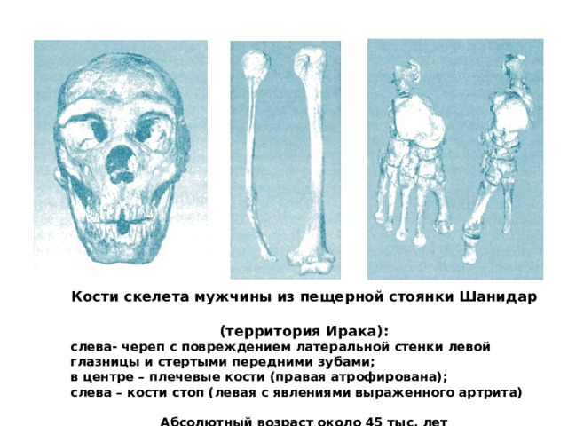 Кости скелета мужчины из пещерной стоянки Шанидар  (территория Ирака): слева- череп с повреждением латеральной стенки левой глазницы и стертыми передними зубами; в центре – плечевые кости (правая атрофирована); слева – кости стоп (левая с явлениями выраженного артрита)   Абсолютный возраст около 45 тыс. лет