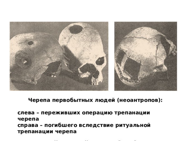 Черепа первобытных людей (неоантропов):  слева – переживших операцию трепанации черепа справа – погибшего вследствие ритуальной трепанации черепа  Копенгаген. Национальный музей