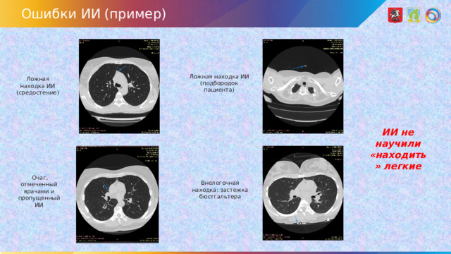 Ошибки ИИ (пример) Ложная находка ИИ (подбородок пациента) Ложная находка ИИ (средостение) ИИ не научили «находить» легкие   Очаг, отмеченный врачами и пропущенный ИИ Внелегочная находка: застежка бюстгальтера
