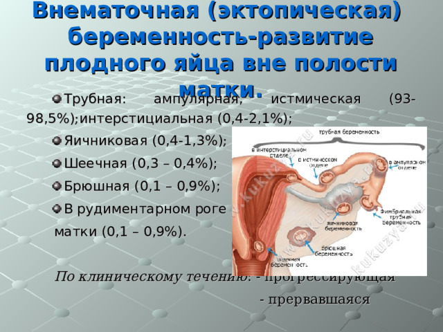 Внематочная (эктопическая) беременность-развитие плодного яйца вне полости матки. Трубная: ампулярная, истмическая (93-98,5%) ; интерстициальная (0,4-2,1%); Яичниковая (0,4-1,3%) ; Шеечная (0,3 – 0,4%); Брюшная (0,1 – 0,9%); В рудиментарном роге матки (0,1 – 0,9%) .  По клиническому течению : - прогрессирующая  - прервавшаяся