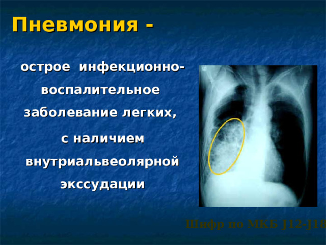 Пневмония -    острое инфекционно-воспалительное заболевание легких,  с наличием внутриальвеолярной экссудаци и  Шифр по МКБ J12-J18
