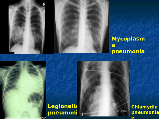 Mycoplasma pneumonia Legionella pneumo nia  Chlamydia pneumoniae