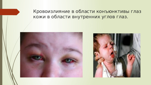 Кровоизлияние в области конъюнктивы глаз кожи в области внутренних углов глаз.