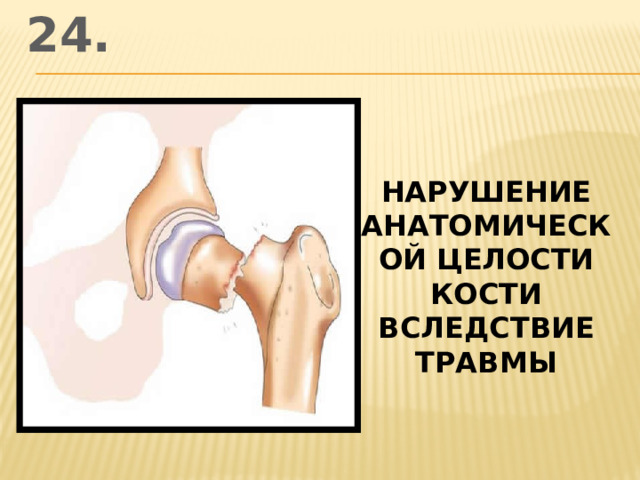 24. нарушение анатомической целости кости вследствие травмы