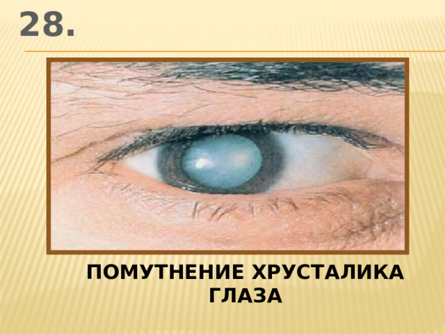 28. помутнение хрусталика глаза