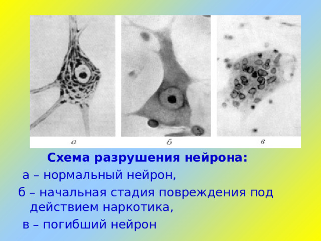 Схема разрушения нейрона:  а – нормальный нейрон, б – начальная стадия повреждения под действием наркотика,  в – погибший нейрон