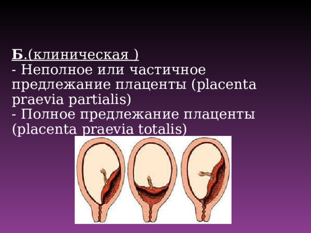 Б .(клиническая ) - Неполное или частичное предлежание плаценты (placenta praevia partialis) - Полное предлежание плаценты (placenta praevia totalis )