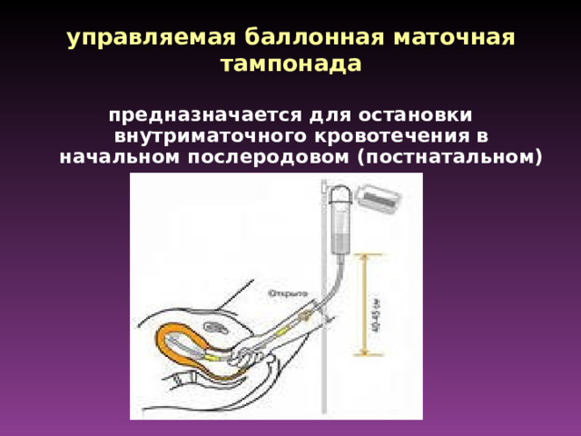 управляемая баллонная маточная тампонада    предназначается для остановки внутриматочного кровотечения в начальном послеродовом (постнатальном) периоде