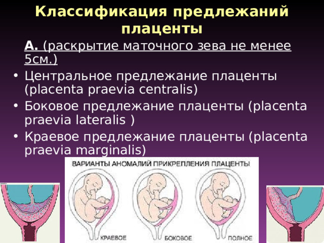 Классификация предлежаний плаценты  А. (раскрытие маточного зева не менее 5см.) Центральное предлежание плаценты (placenta praevia centralis ) Боковое предлежание плаценты (placenta praevia lateralis ) Краевое предлежание плаценты (placenta praevia marginalis )