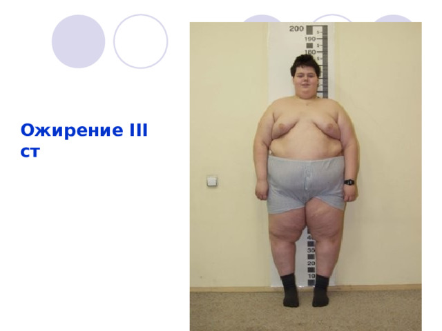 Ожирение III ст