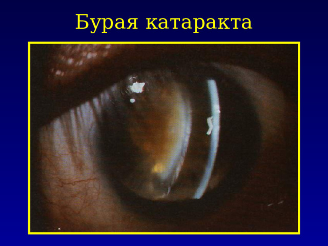 Бурая катаракта