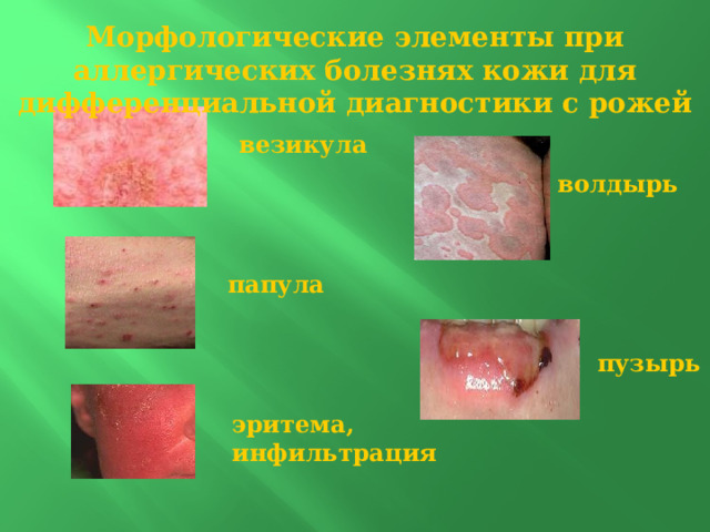 Морфологические элементы при аллергических болезнях кожи для дифференциальной диагностики с рожей   везикула    волдырь  папула   пузырь эритема, инфильтрация