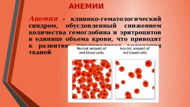 АНЕМИИ Анемия - клинико-гематологический синдром, обусловленный снижением количества гемоглобина и эритроцитов в единице объема крови, что приводит к развитию кислородного голодания тканей