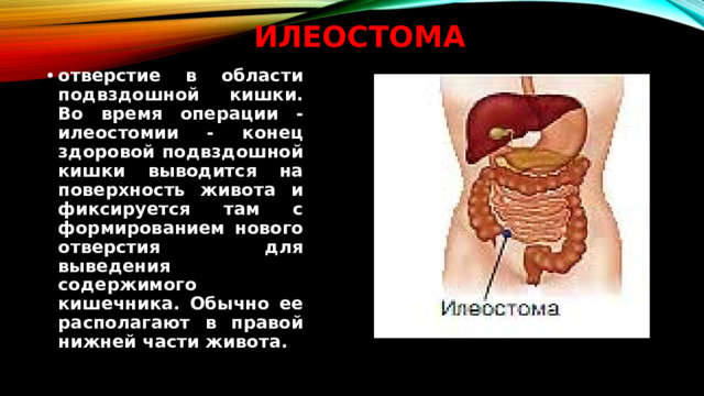 Илеостома отверстие в области подвздошной кишки. Во время операции - илеостомии - конец здоровой подвздошной кишки выводится на поверхность живота и фиксируется там с формированием нового отверстия для выведения содержимого кишечника. Обычно ее располагают в правой нижней части живота.