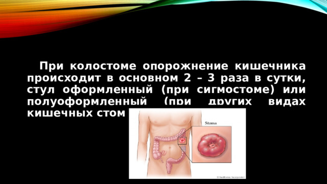 При колостоме опорожнение кишечника происходит в основном 2 – 3 раза в сутки, стул оформленный (при сигмостоме) или полуоформленный (при других видах кишечных стом).