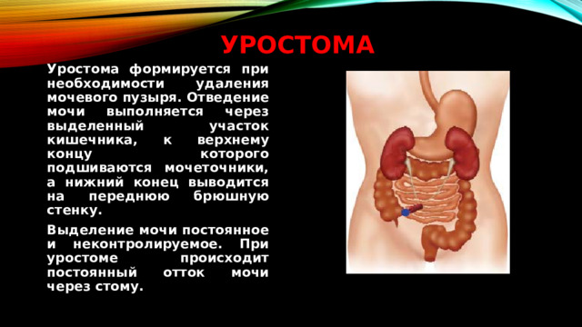 Уростома   Уростома формируется при необходимости удаления мочевого пузыря. Отведение мочи выполняется через выделенный участок кишечника, к верхнему концу которого подшиваются мочеточники, а нижний конец выводится на переднюю брюшную стенку.  Выделение мочи постоянное и неконтролируемое. При уростоме происходит постоянный отток мочи через стому.