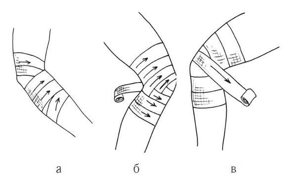 Типы бинтовых повязок и правила их наложения - обж, презентации