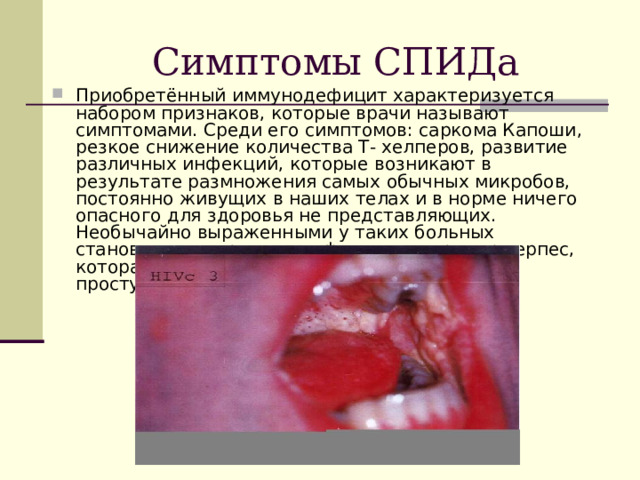 Симптомы СПИДа Приобретённый иммунодефицит характеризуется набором признаков, которые врачи называют симптомами. Среди его симптомов: саркома Капоши, резкое снижение количества Т- хелперов, развитие различных инфекций, которые возникают в результате размножения самых обычных микробов, постоянно живущих в наших телах и в норме ничего опасного для здоровья не представляющих. Необычайно выраженными у таких больных становятся и вирусные инфекции, например герпес, которая по весне выскакивает на губе после простуды.