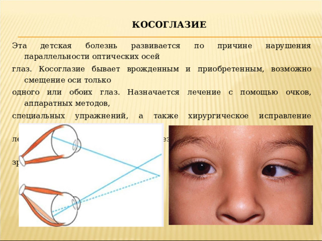 КОСОГЛАЗИЕ Эта детская болезнь развивается по причине нарушения параллельности оптических осей глаз. Косоглазие бывает врожденным и приобретенным, возможно смещение оси только одного или обоих глаз. Назначается лечение с помощью очков, аппаратных методов, специальных упражнений, а также хирургическое исправление дефектов. Отсутствие лечения способно приводить к серьезным нарушениям и значительной потере остроты зрения у детей.