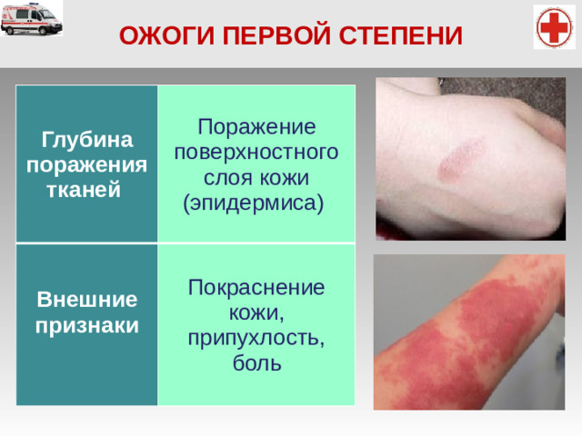 ОЖОГИ ПЕРВОЙ СТЕПЕНИ Глубина поражения тканей Поражение поверхностного слоя кожи (эпидермиса)  Внешние признаки Покраснение кожи, припухлость, боль